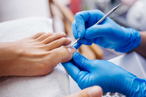 Nagelspangentechnik